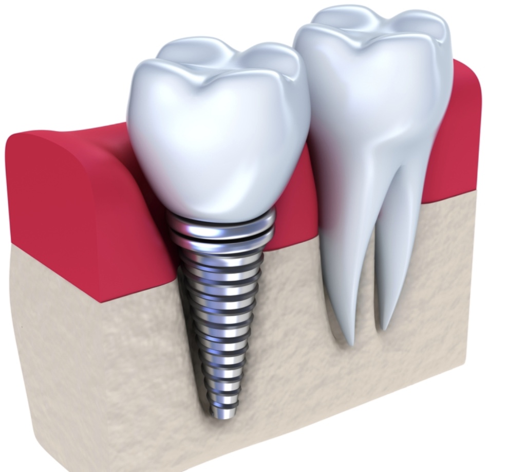 Implant dentaire : Quand utiliser un implant dentaire ?