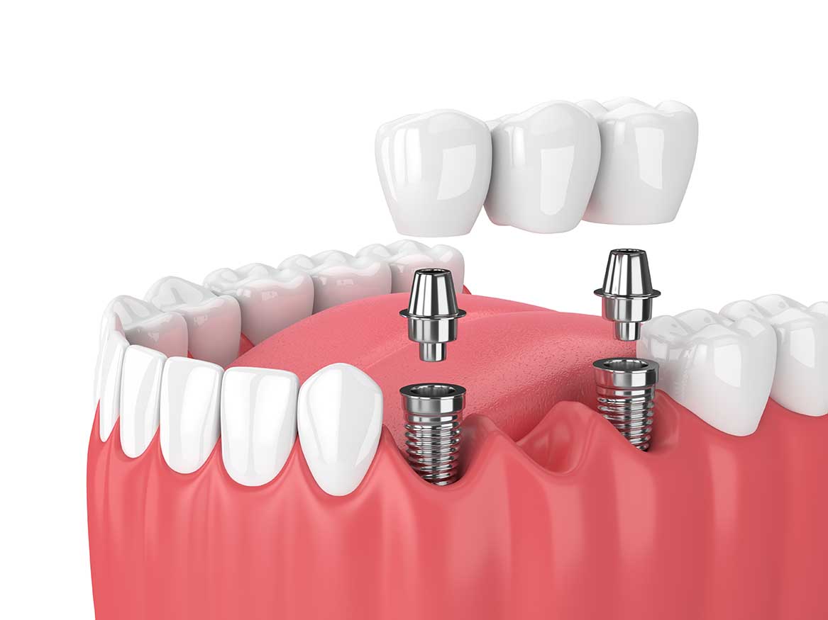 Implant dentaire Lyon : quels sont ses avantages ?